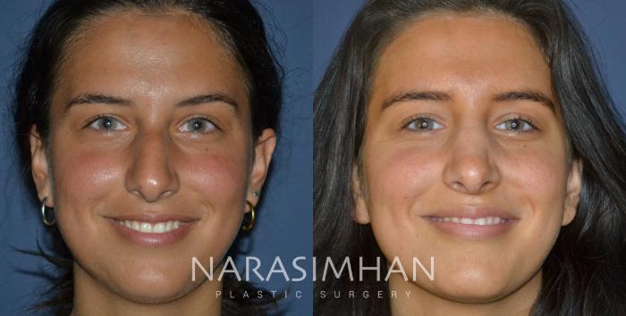 Before & After Rhinoplasty Case 246 View #3 View in Tampa, Florida