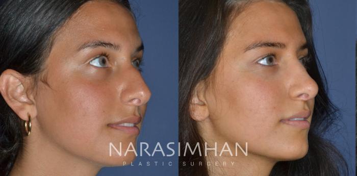 Before & After Rhinoplasty Case 246 View #4 View in Tampa, Florida
