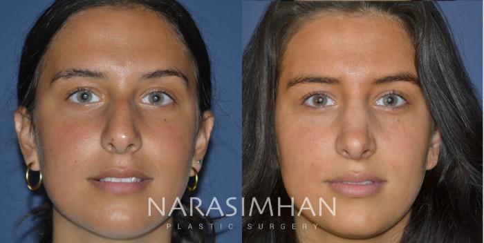 Before & After Rhinoplasty Case 246 View #5 View in Tampa, Florida
