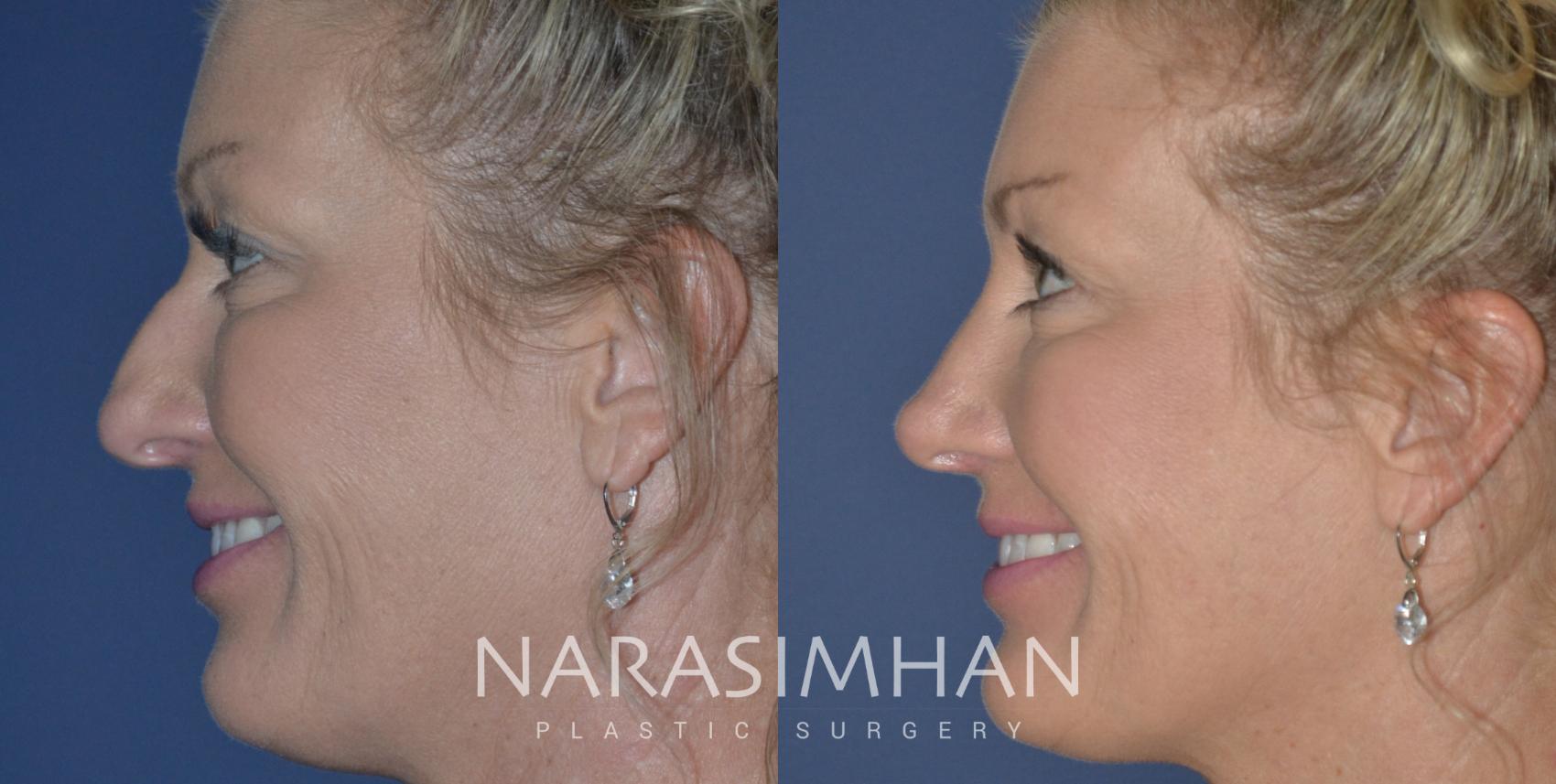 Before & After Rhinoplasty Case 250 View #1 View in Tampa, Florida