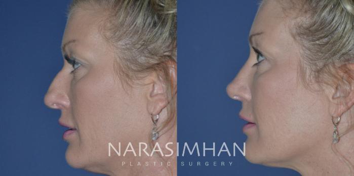 Before & After Rhinoplasty Case 250 View #2 View in Tampa, Florida