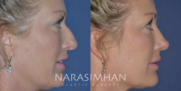 Before & After Rhinoplasty Case 250 View #3 View in Tampa, Florida
