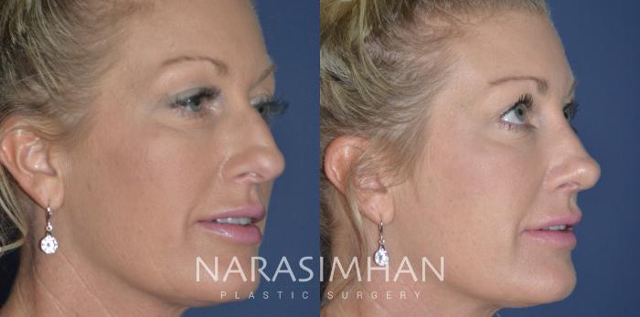 Before & After Rhinoplasty Case 250 View #4 View in Tampa, Florida