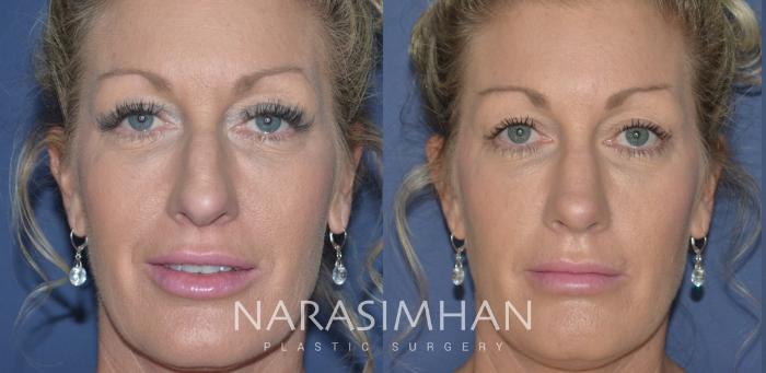 Before & After Rhinoplasty Case 250 View #5 View in Tampa, Florida