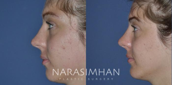 Before & After Rhinoplasty Case 253 View #1 View in Tampa, Florida