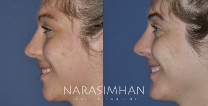 Before & After Rhinoplasty Case 253 View #2 View in Tampa, Florida