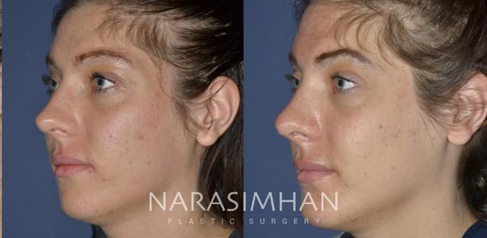 Before & After Rhinoplasty Case 253 View #3 View in Tampa, Florida