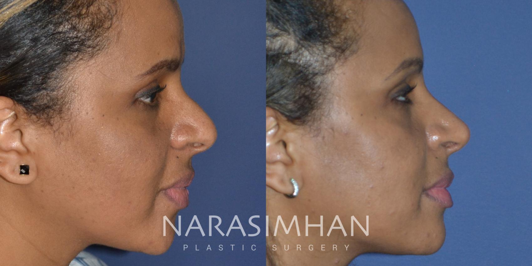 Before & After Rhinoplasty Case 254 View #1 View in Tampa, Florida