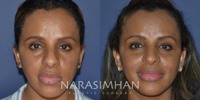 Before & After Rhinoplasty Case 254 View #2 View in Tampa, Florida