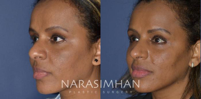 Before & After Rhinoplasty Case 254 View #3 View in Tampa, Florida