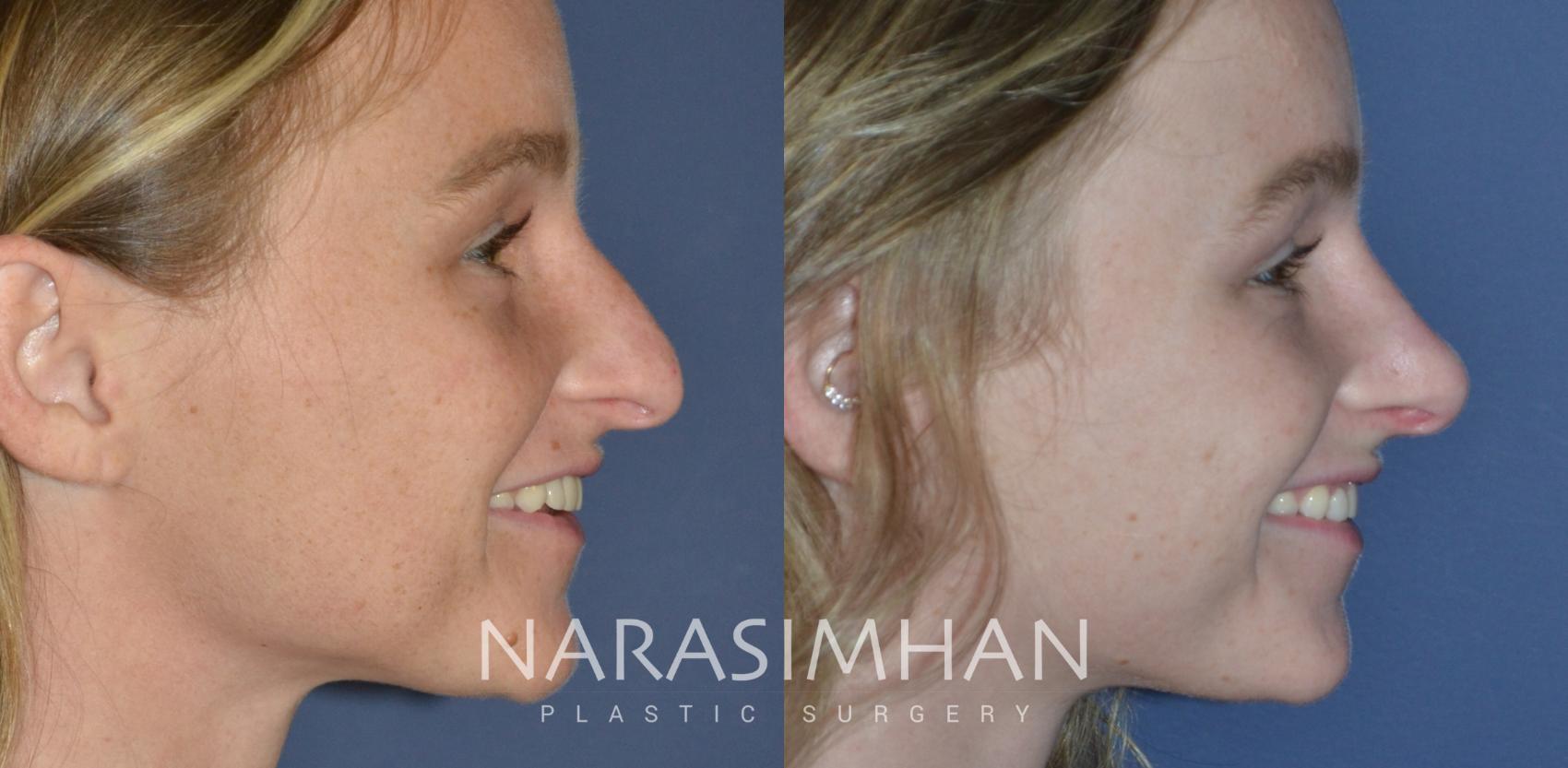 Before & After Rhinoplasty Case 270 View #1 View in Tampa, Florida