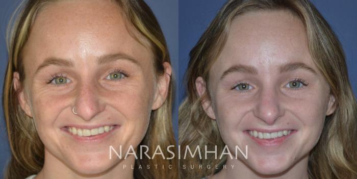 Before & After Rhinoplasty Case 270 View #2 View in Tampa, Florida