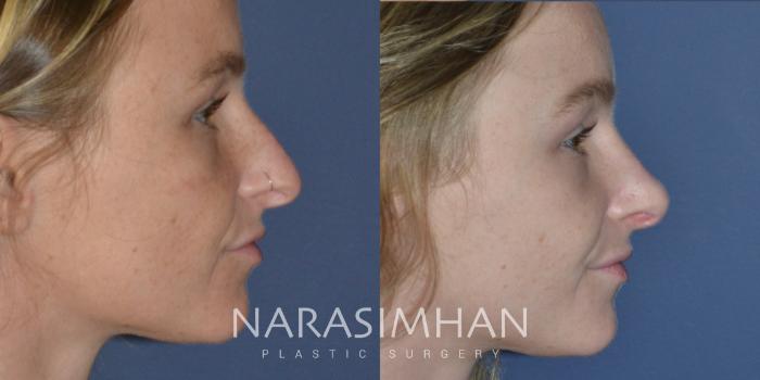 Before & After Rhinoplasty Case 270 View #3 View in Tampa, Florida