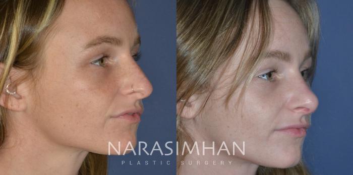 Before & After Rhinoplasty Case 270 View #4 View in Tampa, Florida