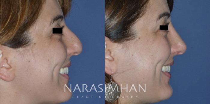 Before & After Rhinoplasty Case 273 View #1 View in Tampa, Florida