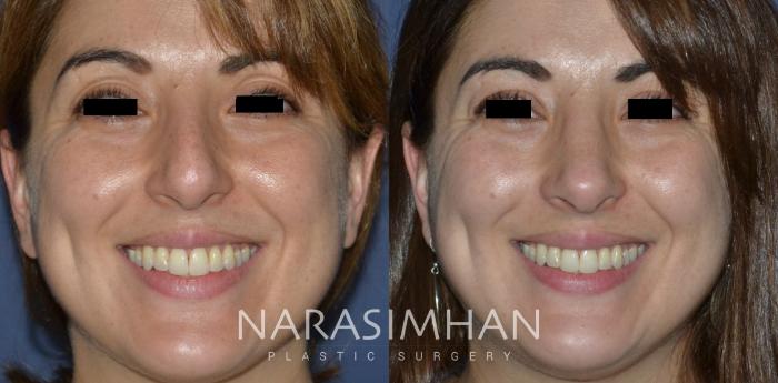 Before & After Rhinoplasty Case 273 View #2 View in Tampa, Florida