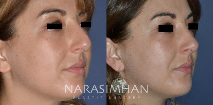 Before & After Rhinoplasty Case 273 View #3 View in Tampa, Florida