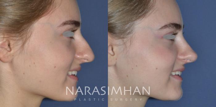 Before & After Rhinoplasty Case 275 View #1 View in Tampa, Florida