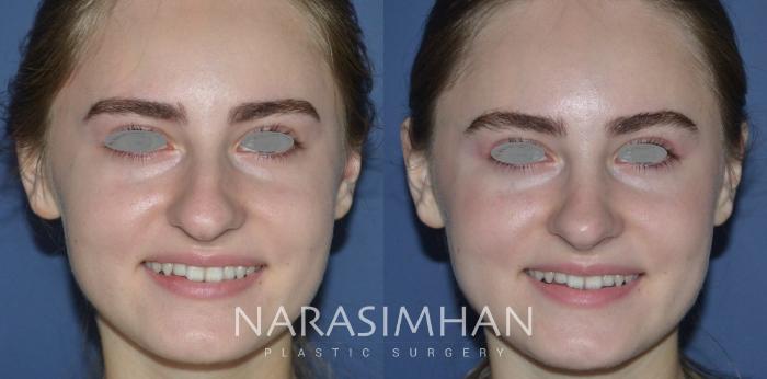 Before & After Rhinoplasty Case 275 View #2 View in Tampa, Florida