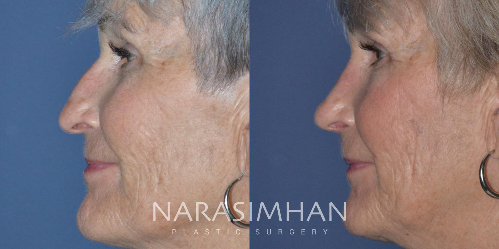 Before & After Rhinoplasty Case 276 View #1 View in Tampa, Florida