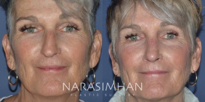 Before & After Rhinoplasty Case 276 View #2 View in Tampa, Florida