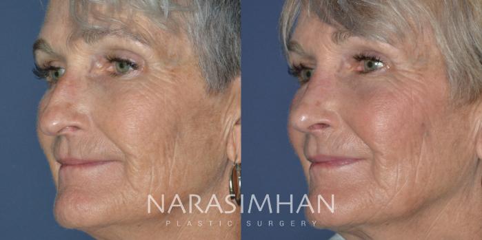 Before & After Rhinoplasty Case 276 View #3 View in Tampa, Florida