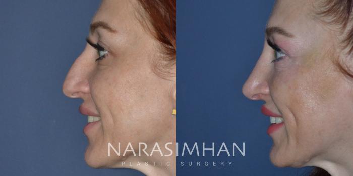 Before & After Rhinoplasty Case 277 View #1 View in Tampa, Florida