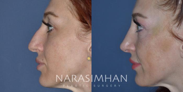 Before & After Rhinoplasty Case 277 View #2 View in Tampa, Florida