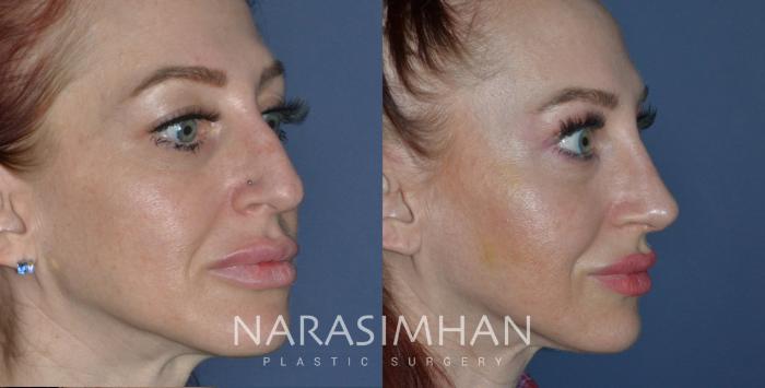 Before & After Rhinoplasty Case 277 View #3 View in Tampa, Florida