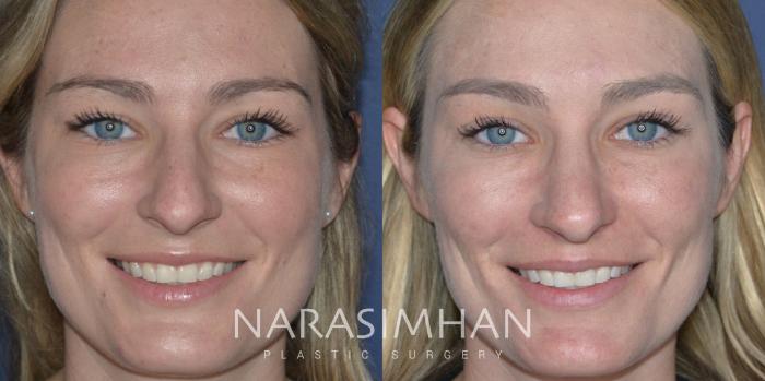 Before & After Rhinoplasty Case 278 Front View in Tampa, Florida