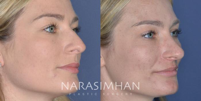 Before & After Rhinoplasty Case 278 Right Oblique View in Tampa, Florida