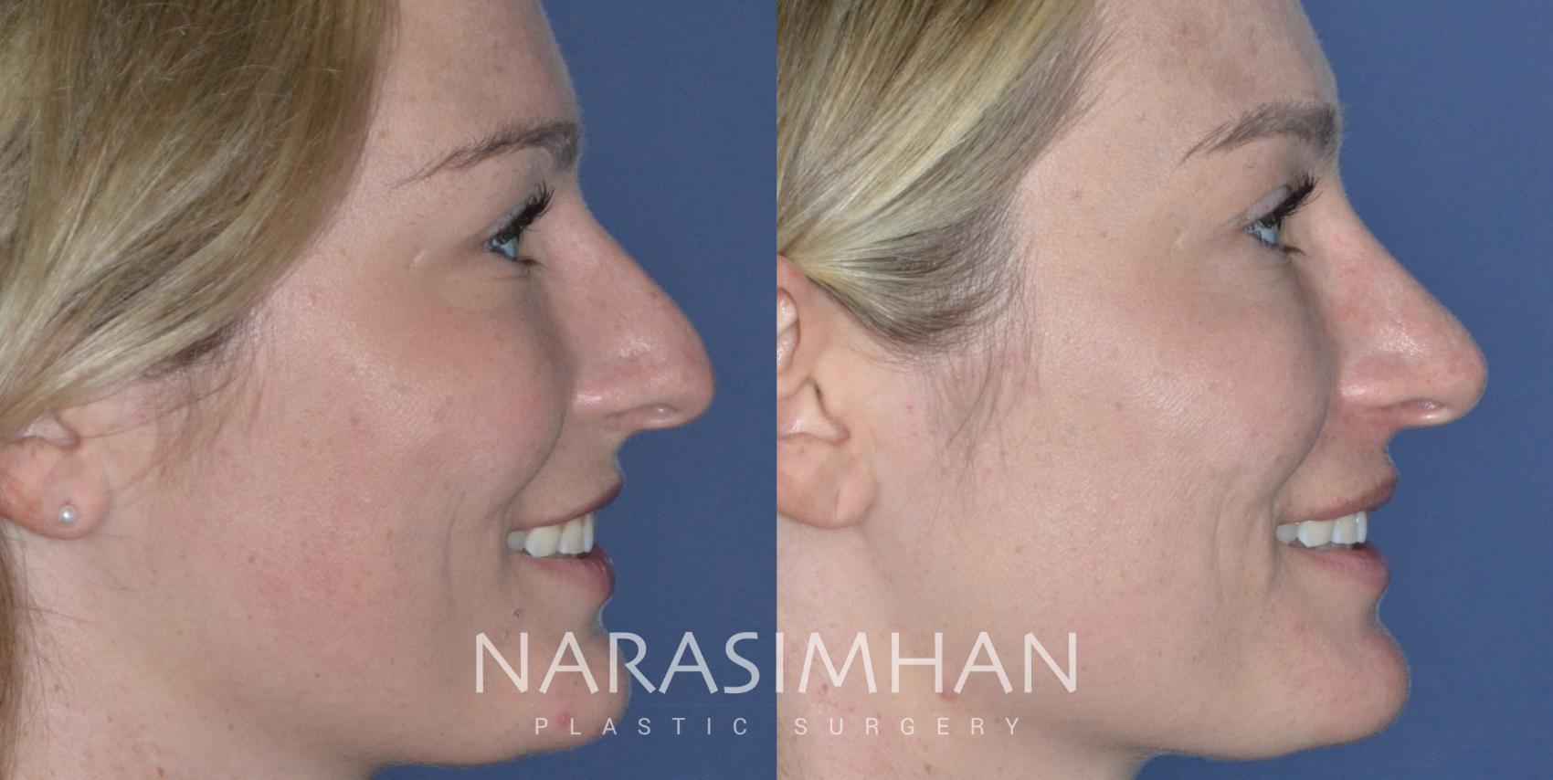 Before & After Rhinoplasty Case 278 Right Side View in St Petersburg, Florida