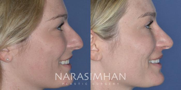 Before & After Rhinoplasty Case 278 Right Side View in Tampa, Florida