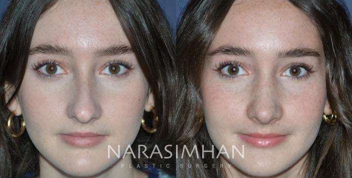 Before & After Rhinoplasty Case 292 Front View in Tampa, Florida