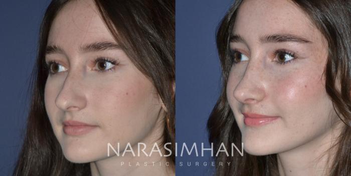 Before & After Rhinoplasty Case 292 Left Oblique View in Tampa, Florida