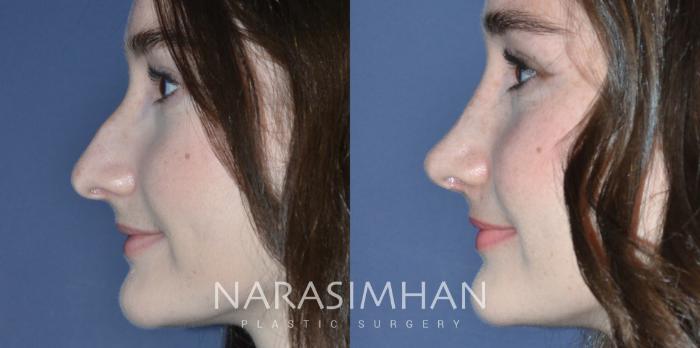 Before & After Rhinoplasty Case 292 Left Side View in Tampa, Florida