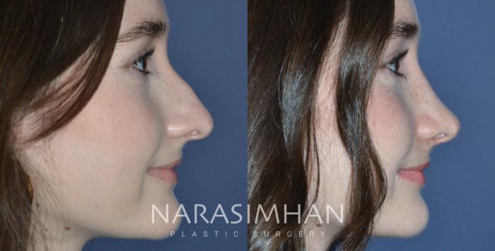 Before & After Rhinoplasty Case 292 Right side smiling View in Tampa, Florida
