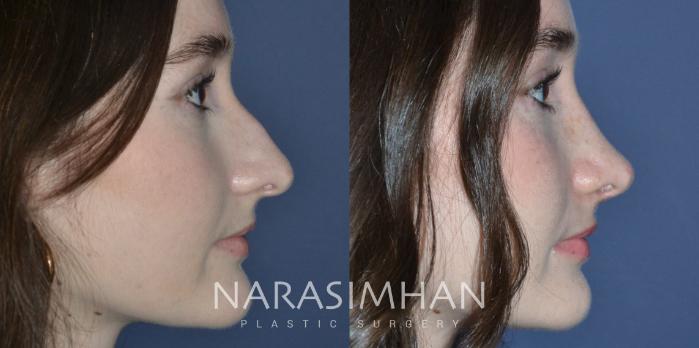 Before & After Rhinoplasty Case 292 Right Side View in Tampa, Florida
