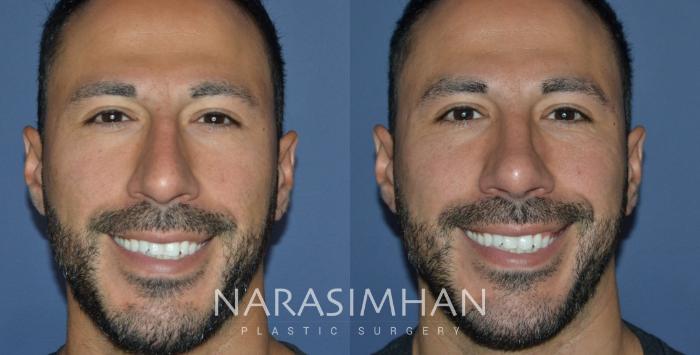Before & After Rhinoplasty Case 294 Front View in Tampa, Florida