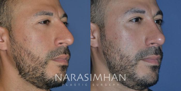 Before & After Rhinoplasty Case 294 Right Oblique View in Tampa, Florida