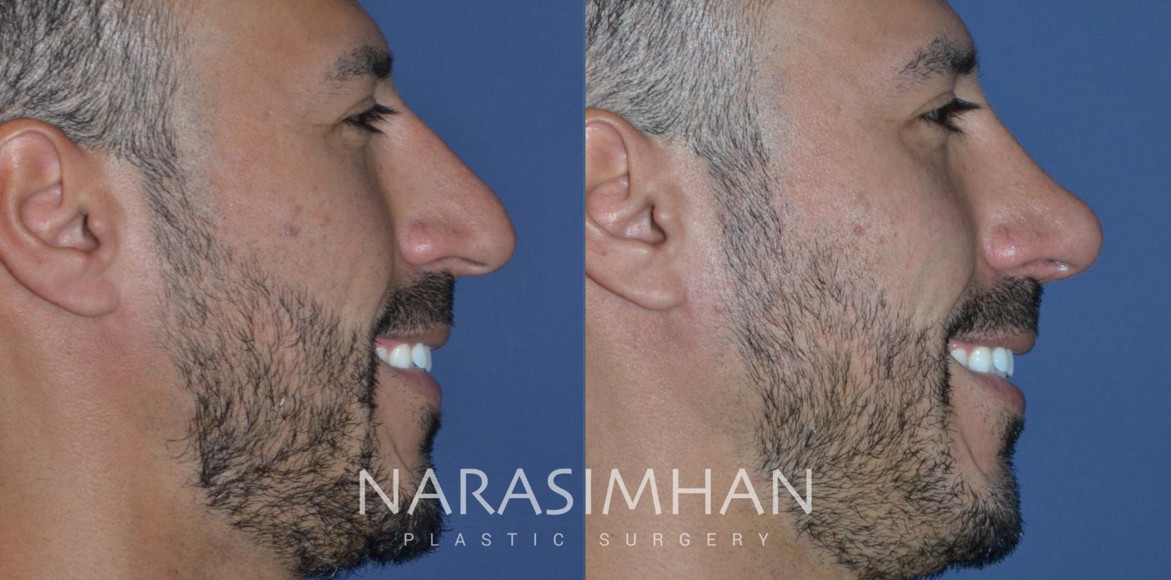 Before & After Ethnic Rhinoplasty Case 294 Right Side View in Tampa, Florida