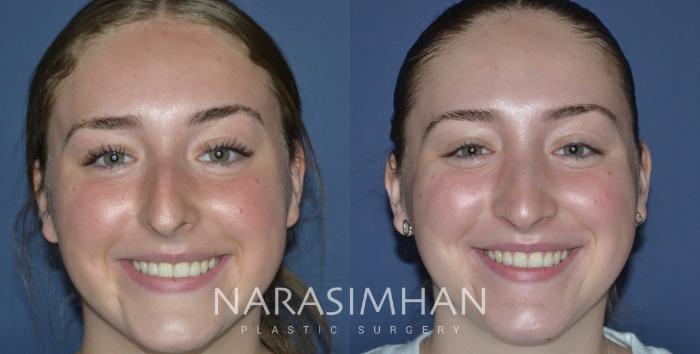 Before & After Rhinoplasty Case 296 Front View in Tampa, Florida