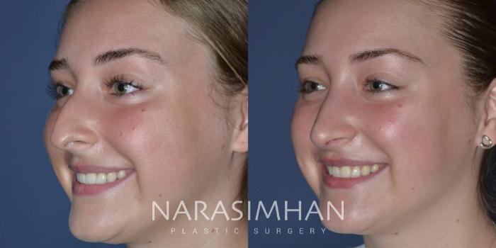 Before & After Rhinoplasty Case 296 Left Oblique View in Tampa, Florida