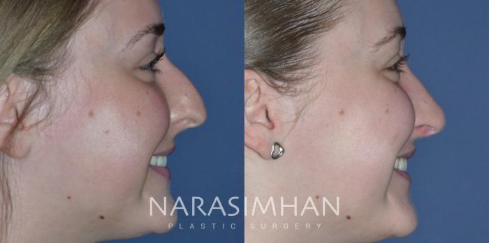 Before & After Rhinoplasty Case 296 Right Side View in Tampa, Florida