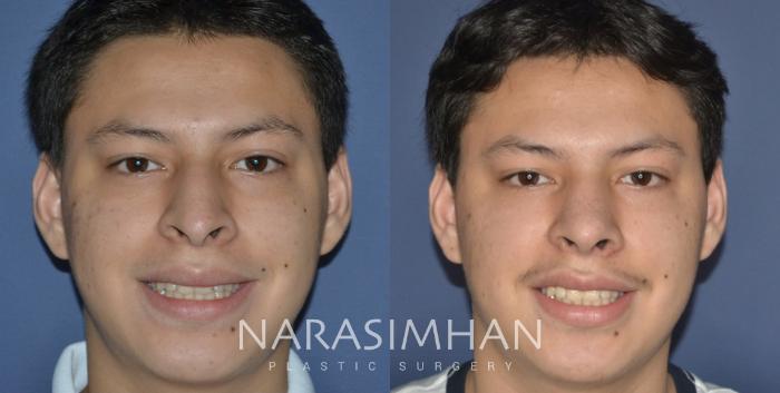 Before & After Ethnic Rhinoplasty Case 299 Front View in Tampa, Florida