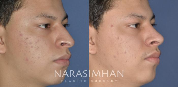 Before & After Ethnic Rhinoplasty Case 299 Right Oblique View in Tampa, Florida