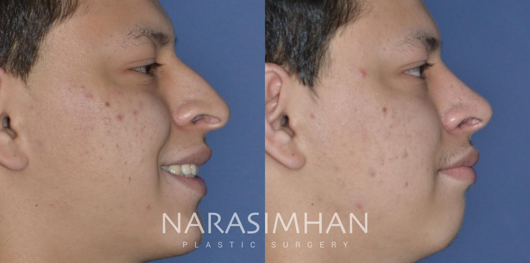 Before & After Ethnic Rhinoplasty Case 299 Right Side View in Tampa, Florida