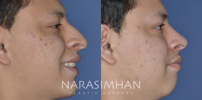 Before & After Rhinoplasty Case 299 Right Side View in Tampa, Florida