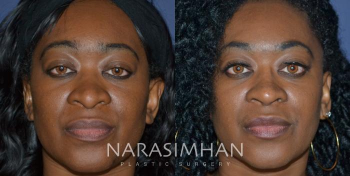 Before & After Ethnic Rhinoplasty Case 301 Front View in Tampa, Florida