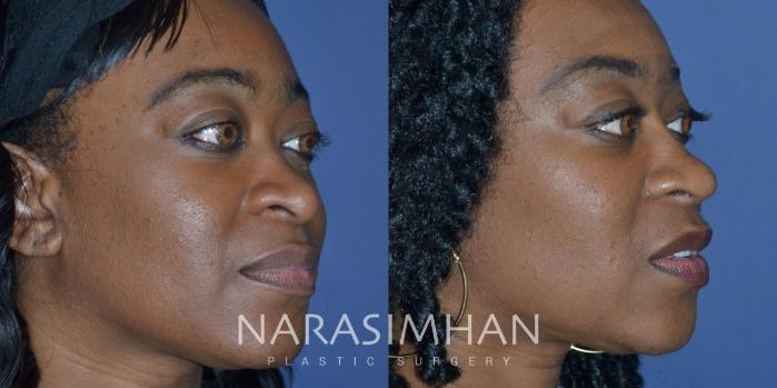 Before & After Ethnic Rhinoplasty Case 301 Right Oblique View in Tampa, Florida